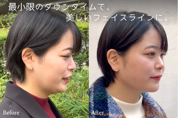 最小限のダウンタイムで、美しいフェイスラインに
