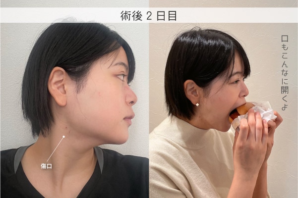 術後2日目
