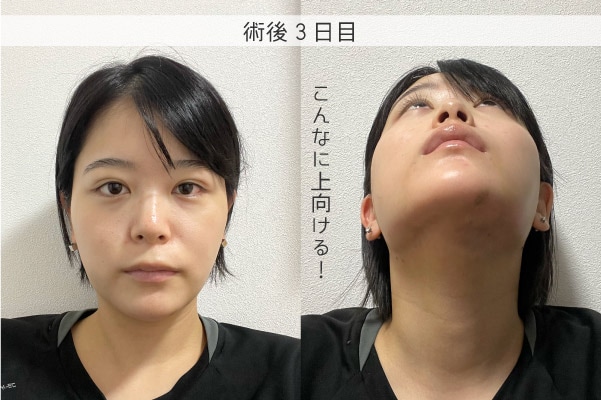 術後3日目
