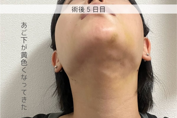 術後5日目