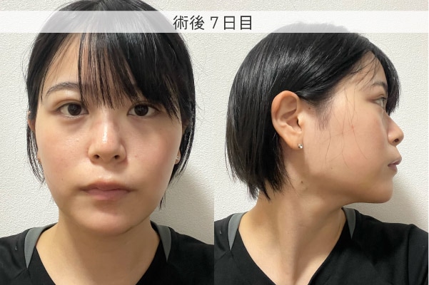 術後7日目