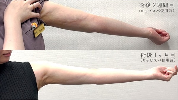2週間で、拘縮のボコつきがここまで改善!