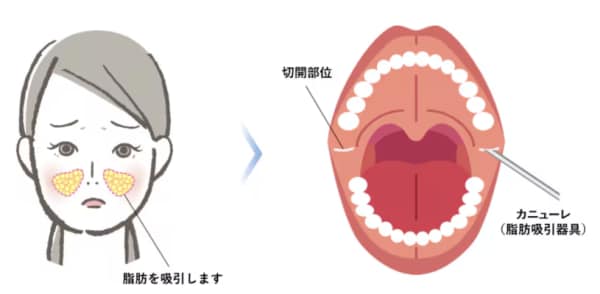 メーラーファット除去の施術方法
