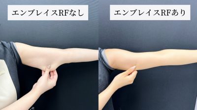 エンブレイスRFをした場合としてない場合の症例