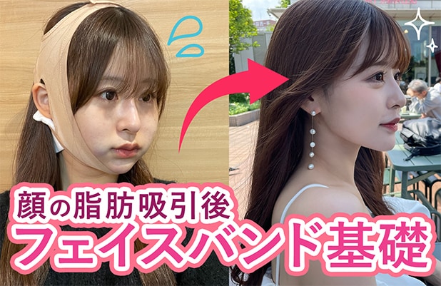 顔の脂肪吸引後の「フェイスバンド」とは？効果・着用期間・注意点を解説
