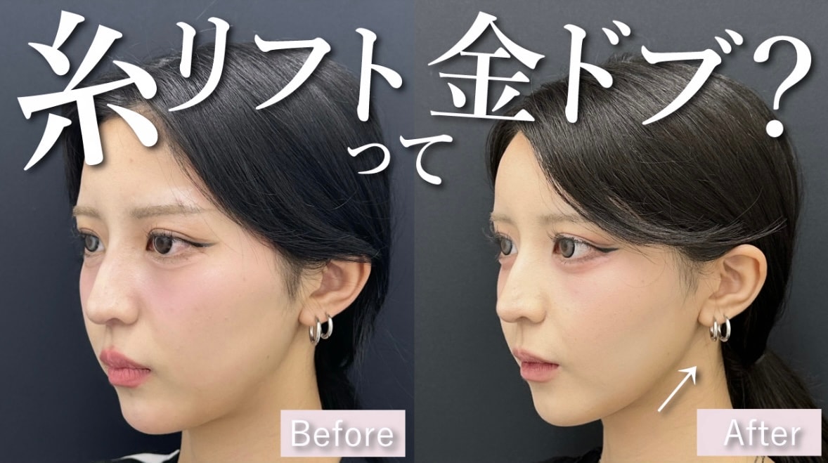 糸リフトは金ドブで効果なし？ダウンタイムの腫れや経過は？