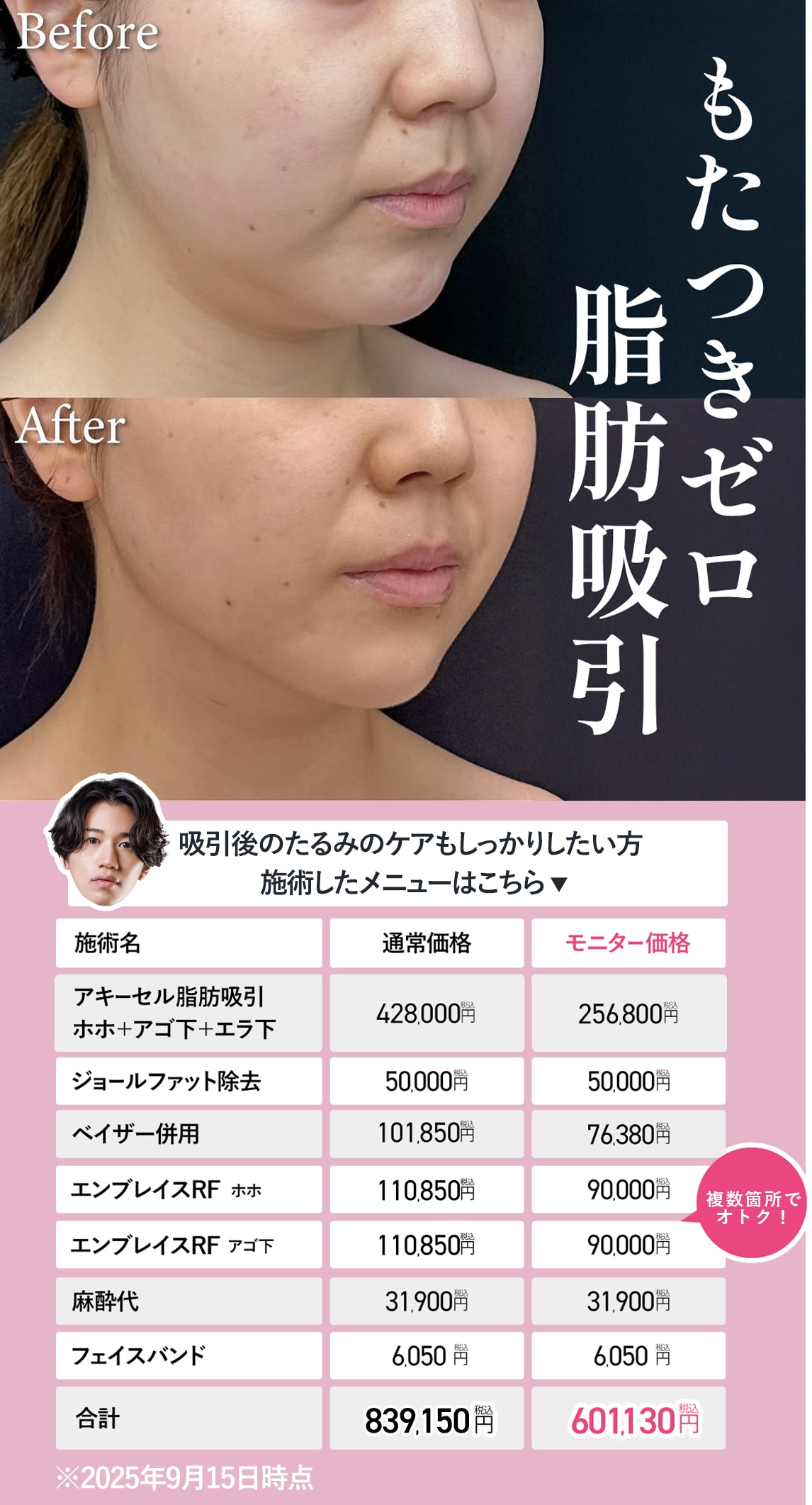 脂肪吸引後のたるみも怖くない！究極の引き締め術