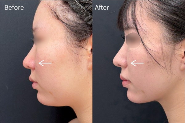 “鼻横の埋もれ感が気になる”