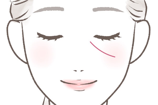 メーラー×ゴルゴ線の脂肪注入