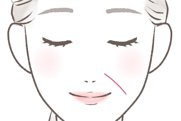 メーラー×ほうれい線脂肪注入