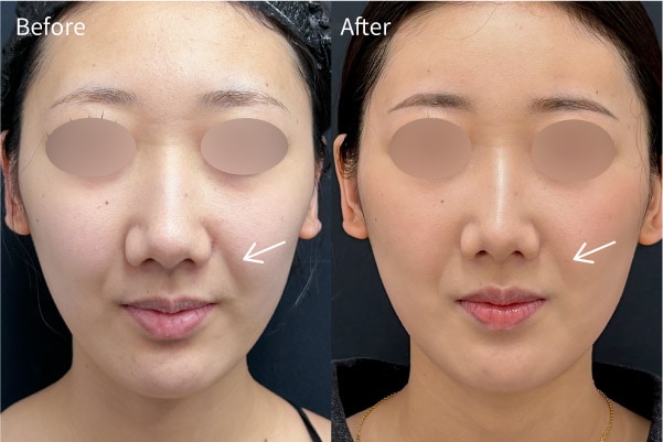 ”ほうれい線を薄くしたい”