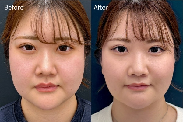 ”頬のボリュームを減らしたい”
