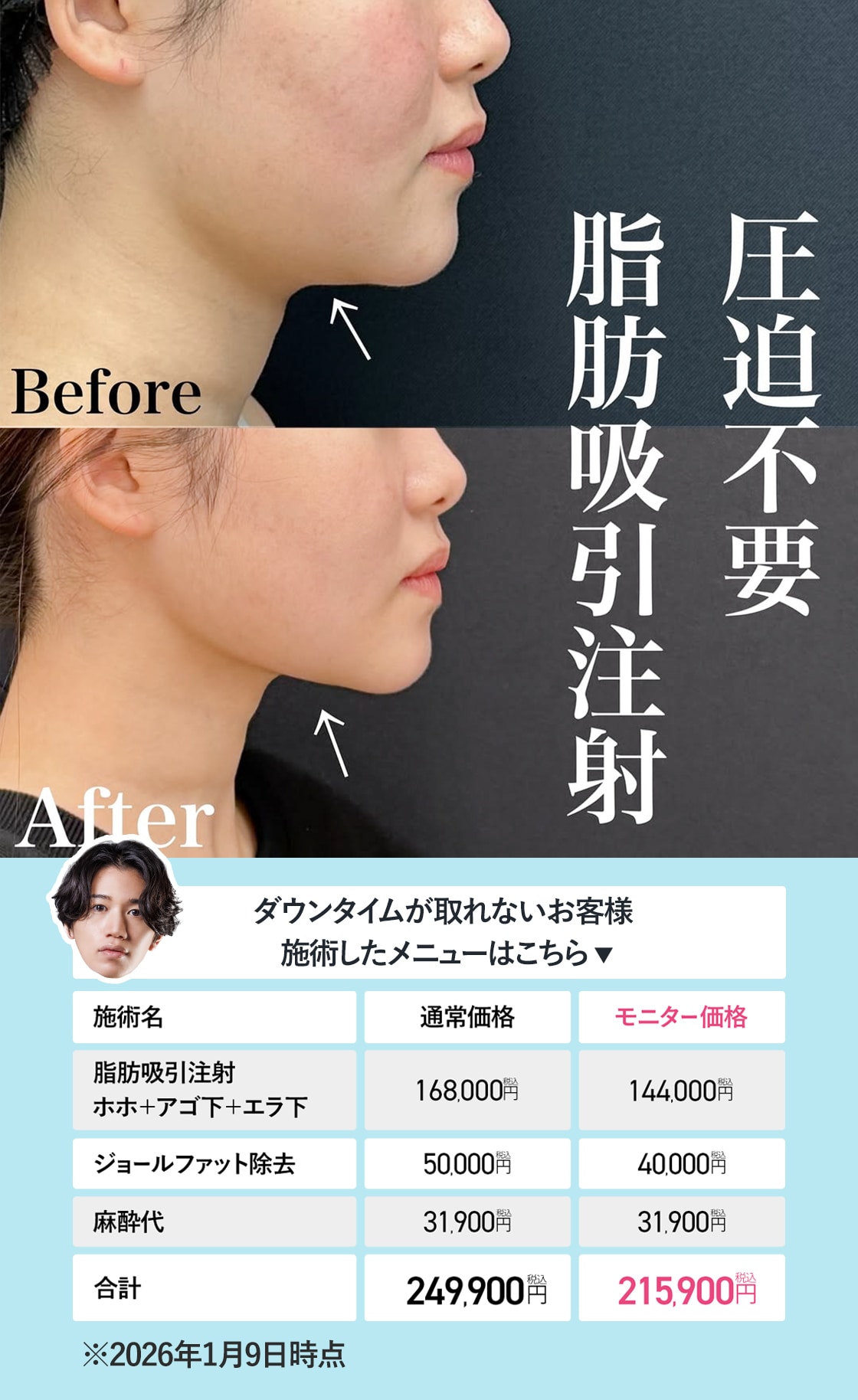 圧迫不要の脂肪吸引注射