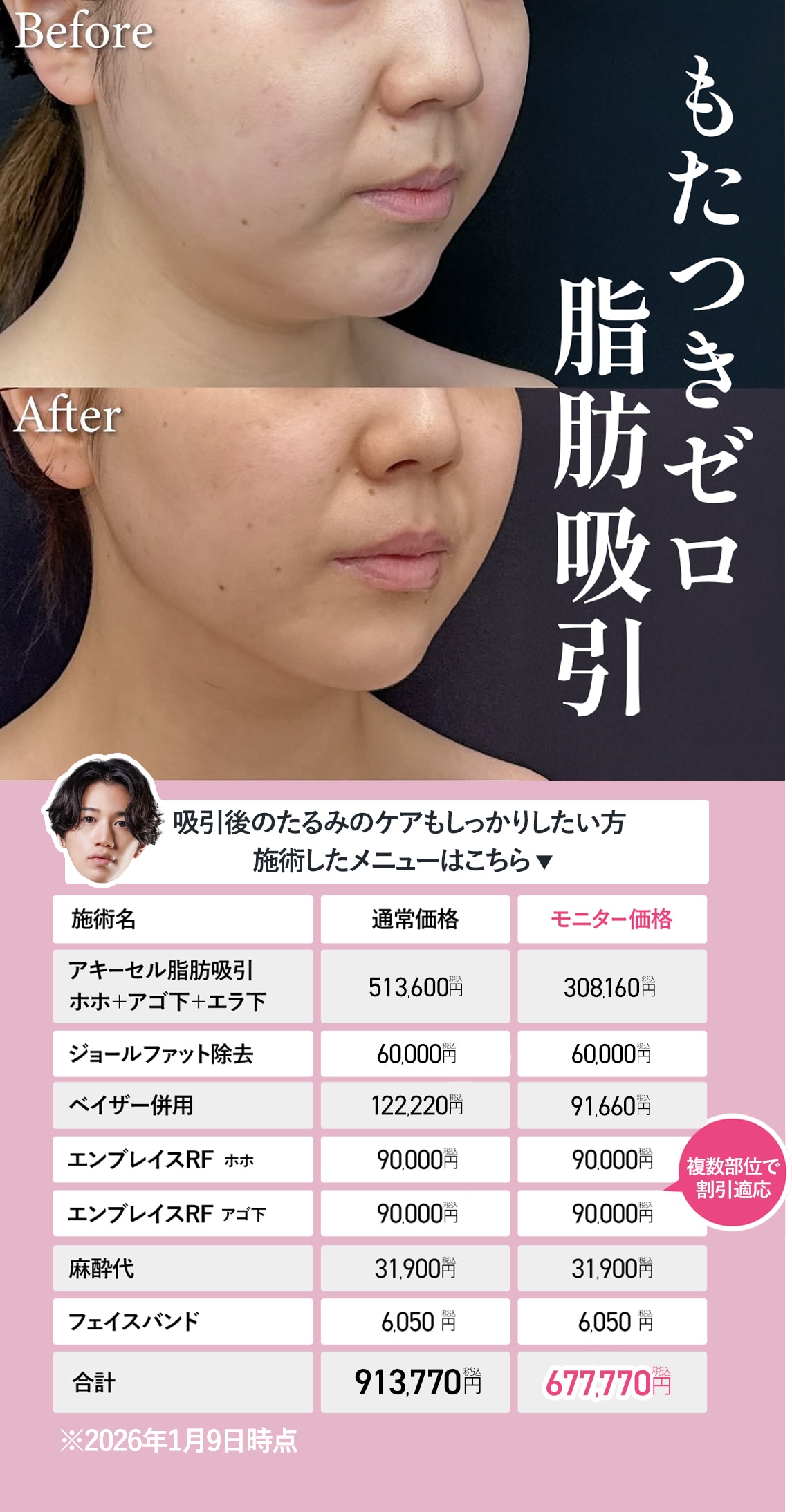 脂肪吸引後のたるみも怖くない！究極の引き締め術