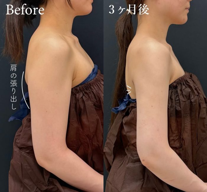 脂肪吸引の劇的なBefore After写真