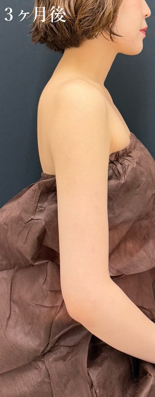 まっすぐ二の腕スッキリ