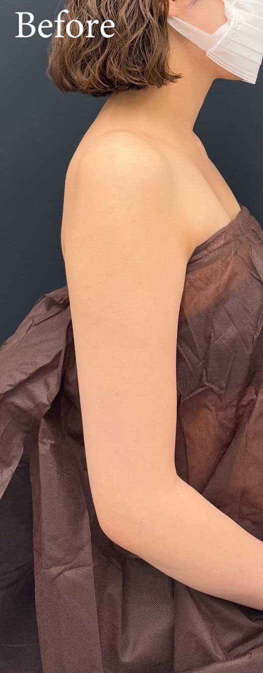 まっすぐ二の腕スッキリ