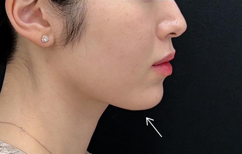 脂肪吸引注射と糸リフトを組み合わせてもたつきゼロへ