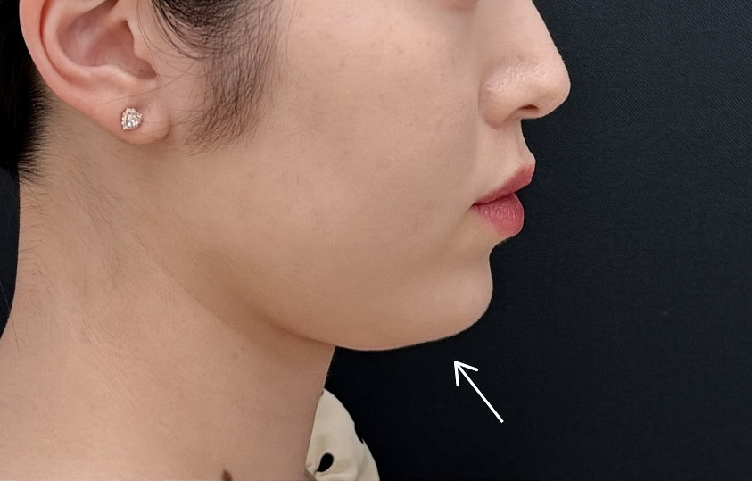 脂肪吸引注射と糸リフトを組み合わせてもたつきゼロへ