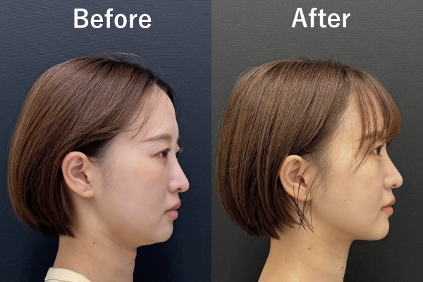 脂肪吸引注射とは