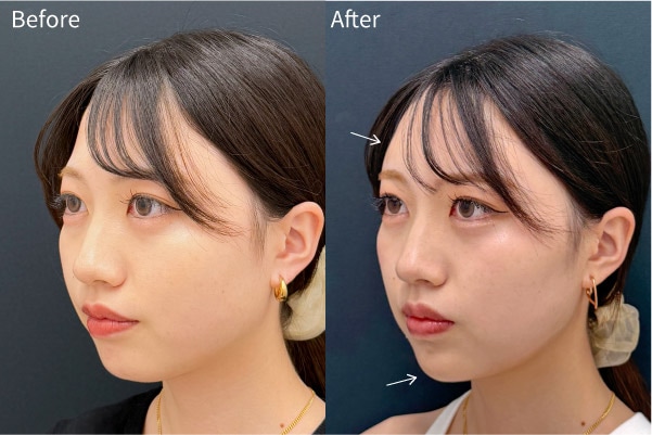 脂肪注入の定着率アップ