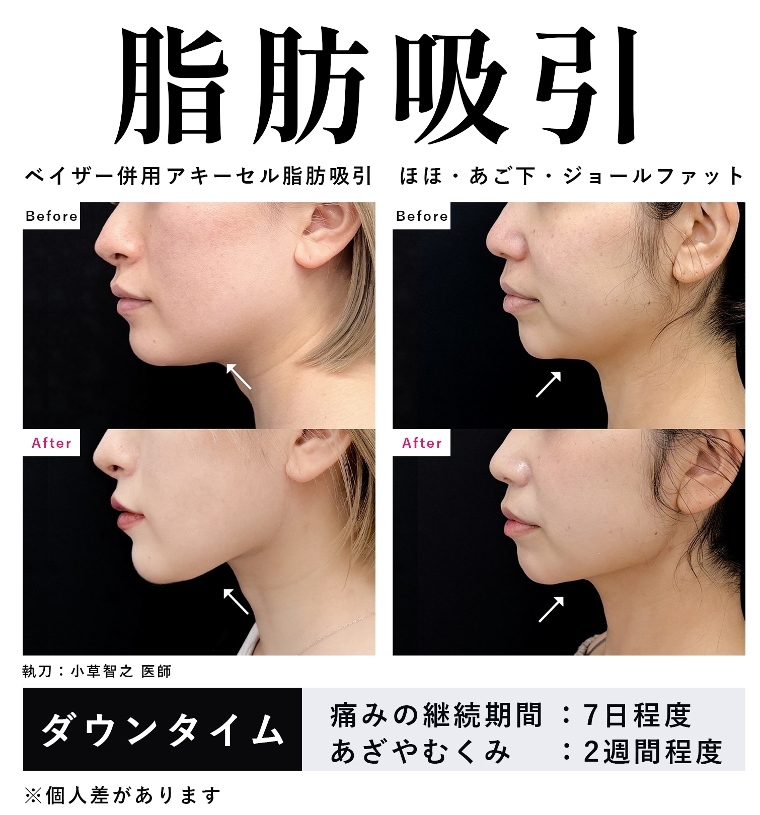 どちらも小顔効果