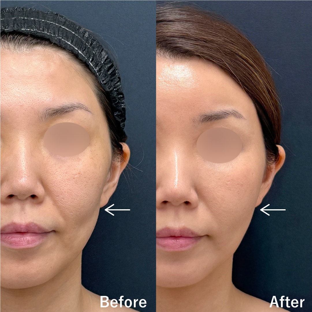 頬こけに脂肪注入は効果的?輪郭手術の名医がわかりやすく解説
