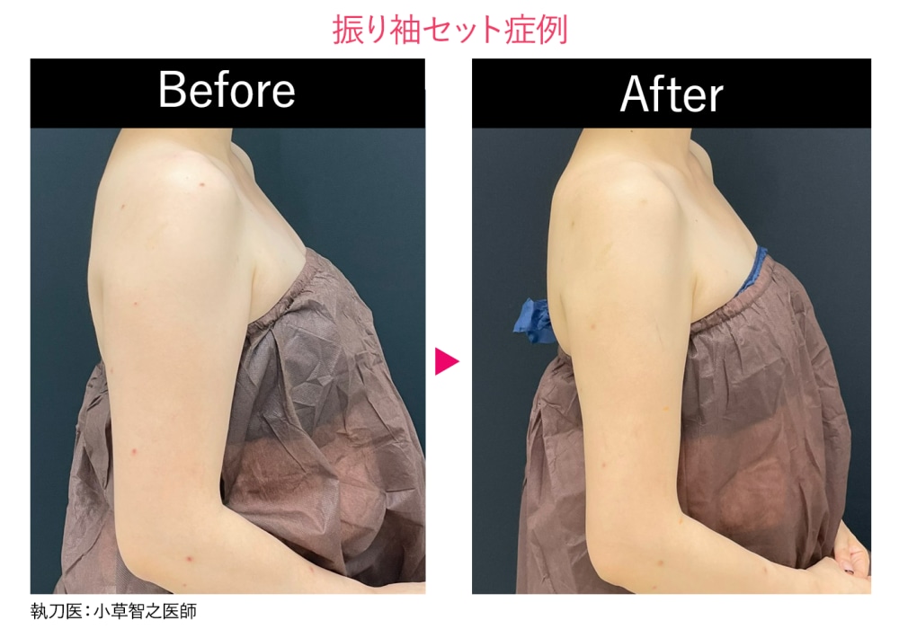 <h3>脂肪を「直接吸い出す」からリバウンドしにくい</h3>