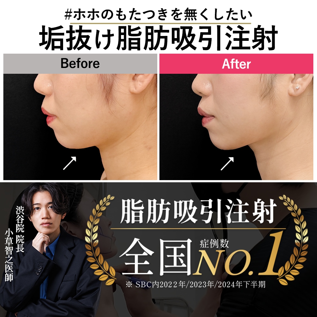 【脂肪吸引注射の名医】29歳の二重あご卒業!ダウンタイムが取れなくても理想の輪郭になれる理由。