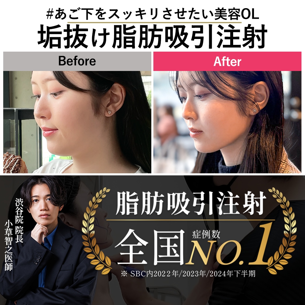 【脂肪吸引注射の名医】が叶える理想のVライン。美容オタクが辿り着いた「あご下スッキリ」