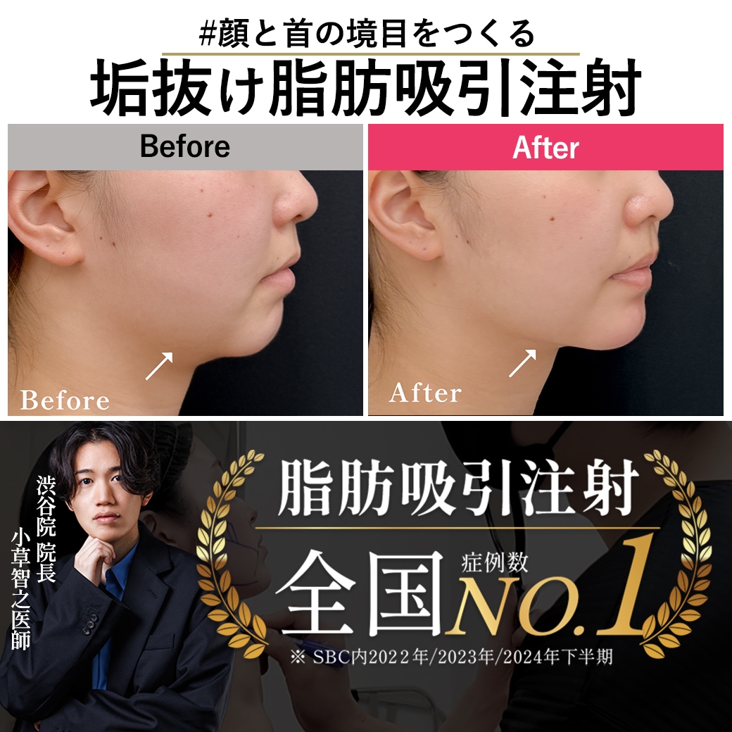 【脂肪吸引注射の名医】脂肪吸引注射で顔と首と境目を作る
