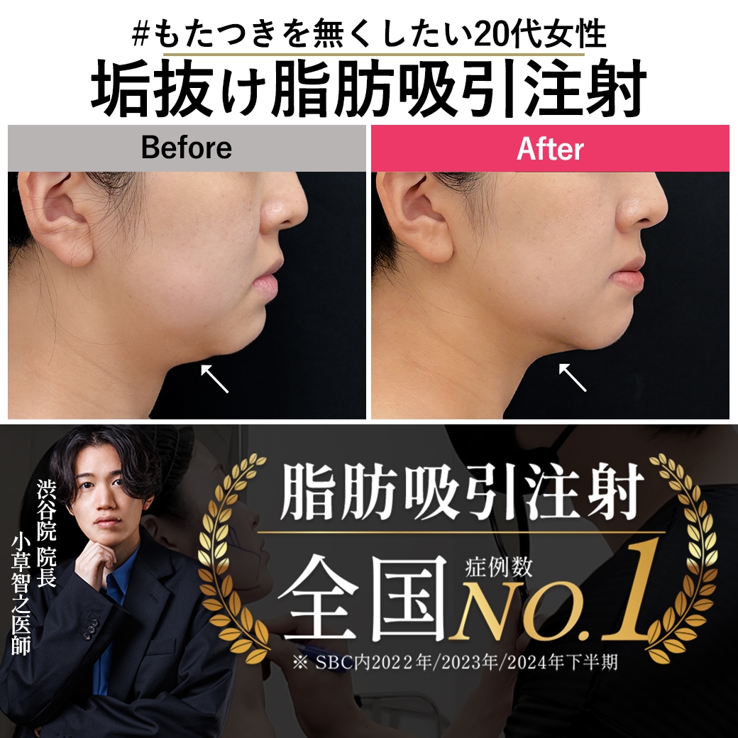 【脂肪吸引注射の名医】もたつきを無くしたい20代