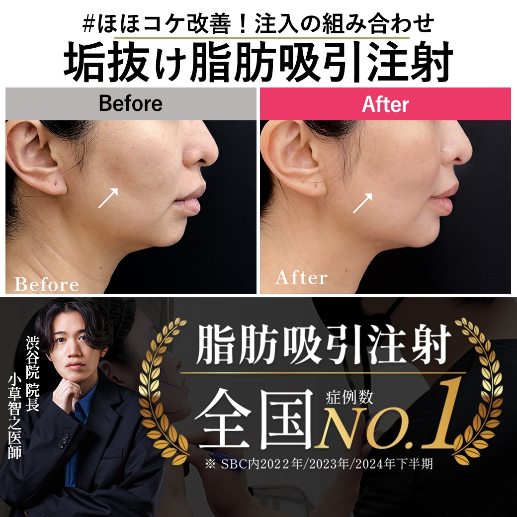 【脂肪吸引注射の名医】脂肪吸引注射×糸リフト×脂肪注入で作る30代の黄金比フェイスライン