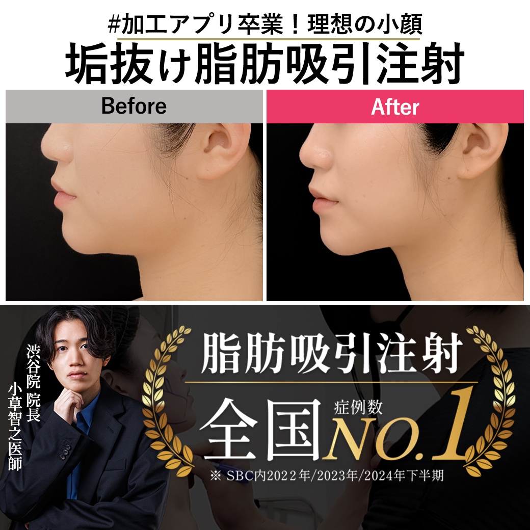 【脂肪吸引注射の名医】もう他撮りも怖くない！あご下スッキリ×ダウンタイム最小限。