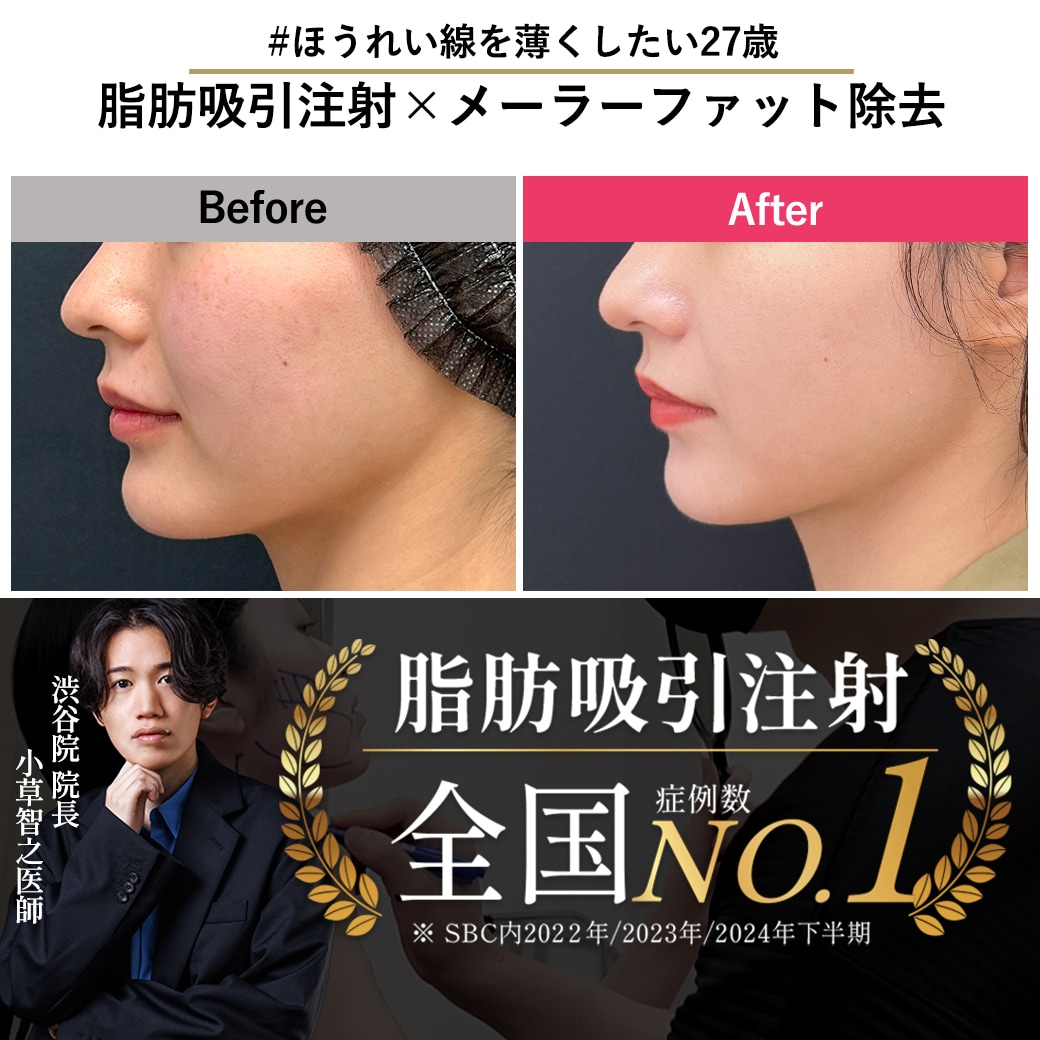 【脂肪吸引注射の名医】脂肪吸引注射×メーラーファット除去でほうれい線を薄く
