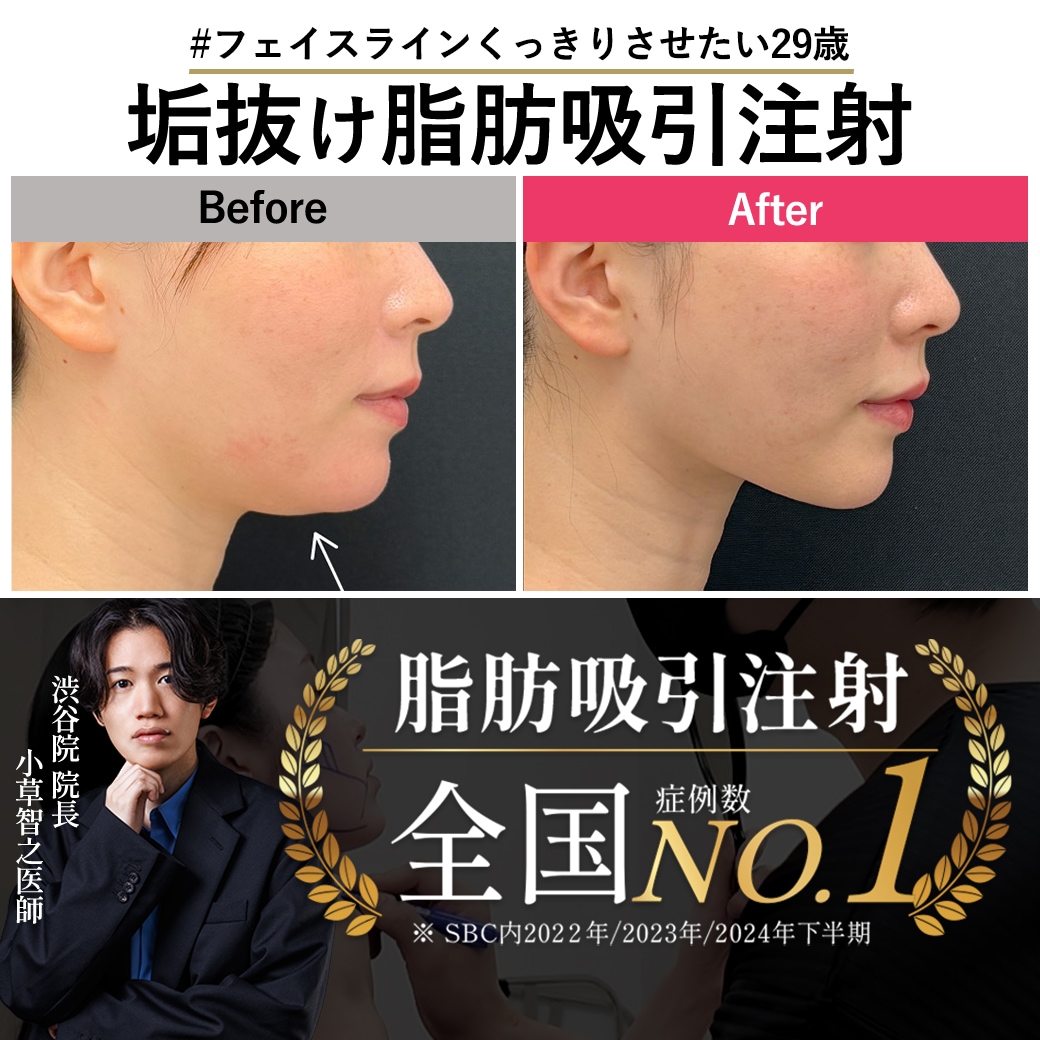 【脂肪吸引注射の名医】”顔と首の境目くっきりさせたい”29歳女性