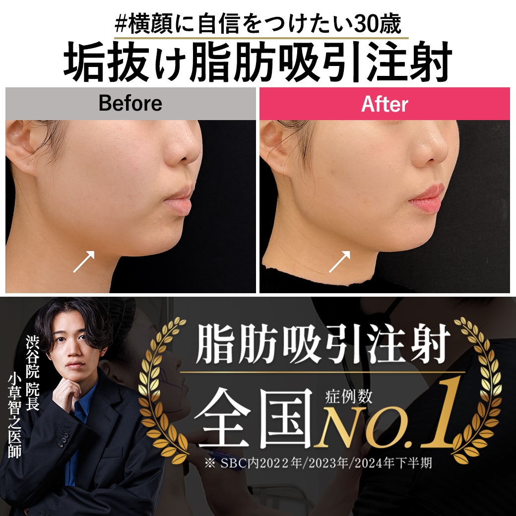 【脂肪吸引注射の名医】横顔に自信を持ちたい30歳垢抜け