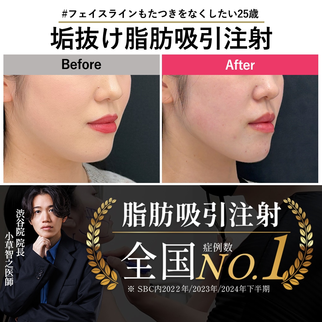 【脂肪吸引注射の名医】ダウンタイム最小限で、もたつきのない輪郭に。