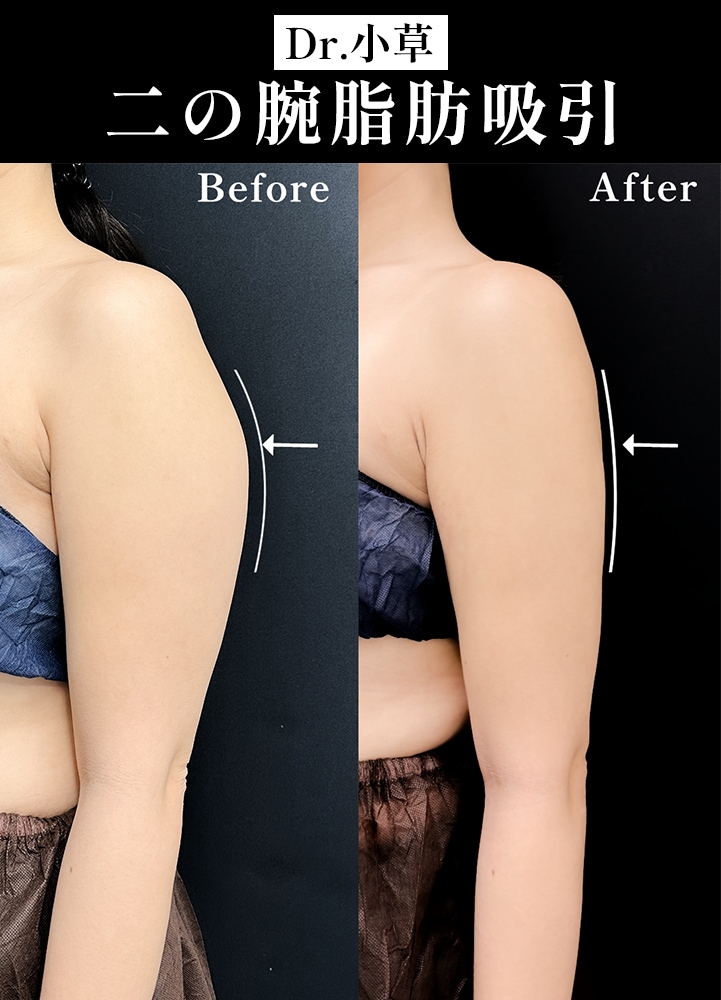 【二の腕脂肪吸引の名医】上半身の厚みを改善【二の腕脂肪吸引が上手いおぐさ先生】