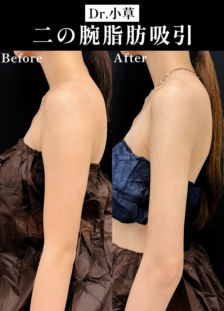 【二の腕脂肪吸引の名医】理想の細さを追求【二の腕脂肪吸引が上手いおぐさ先生】