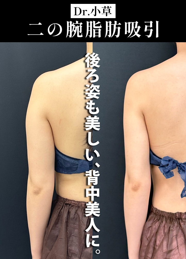 【二の腕脂肪吸引の名医】ドレスが映える華奢なボディに【二の腕脂肪吸引が上手いおぐさ先生】
