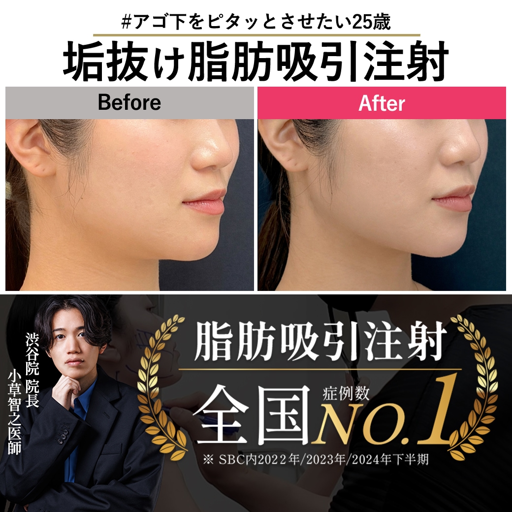 【脂肪吸引注射の名医】「本当に次の日から働けた！」最短で垢抜ける脂肪吸引注射