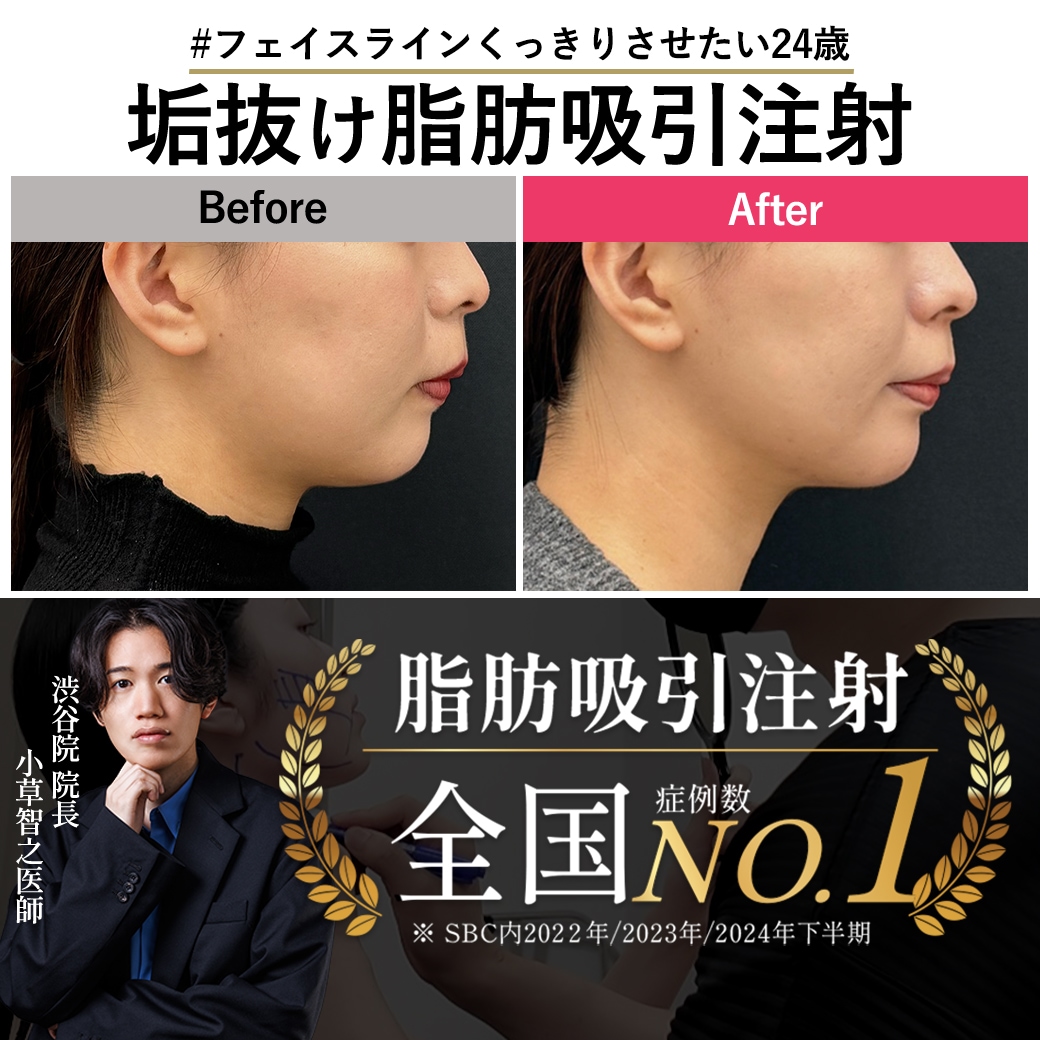 【脂肪吸引注射の名医】誰にもバレずに顔の余白を減らす24歳女性の垢抜け