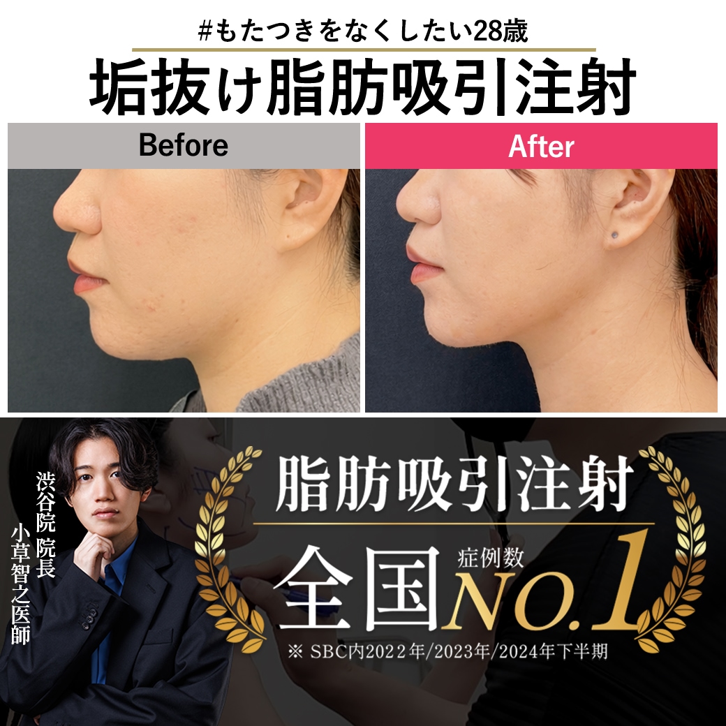 【脂肪吸引注射の名医】ナチュラルだけどしっかり変わる。アラサーのもたつき解消