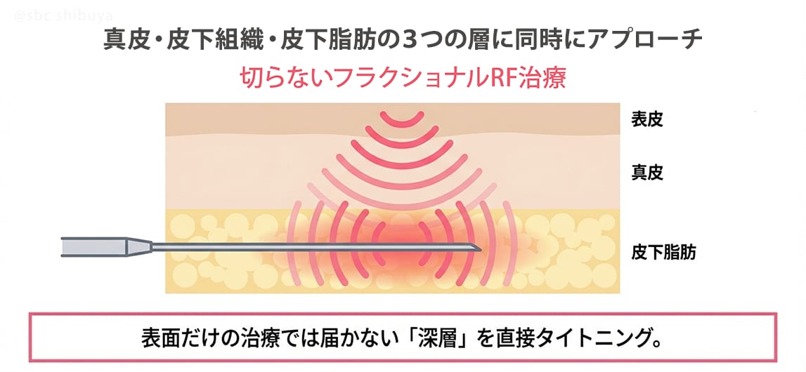 表面からではなく「皮下」へ