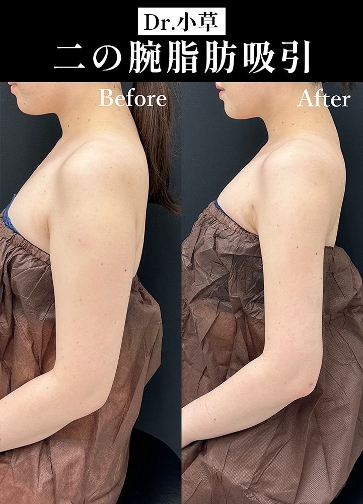 【二の腕脂肪吸引注射の名医】韓国アイドルのような直角ラインを作る【二の腕脂肪吸引が上手い小草先生】