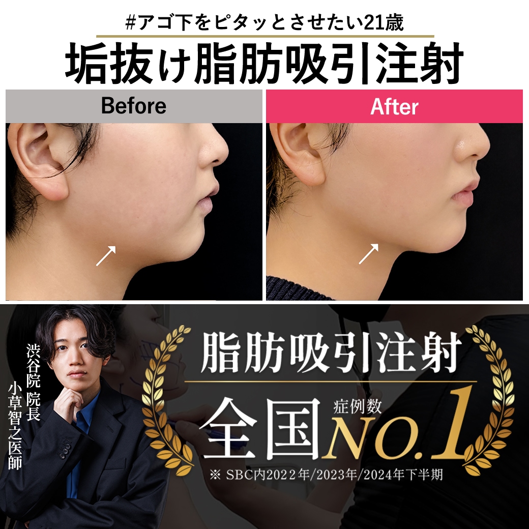 【脂肪吸引注射の名医】21歳のもたつき解消!失敗しない先生の選び方