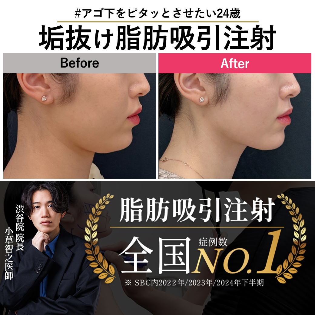 【脂肪吸引注射の名医】脂肪吸引注射×糸リフトで作る無加工輪郭