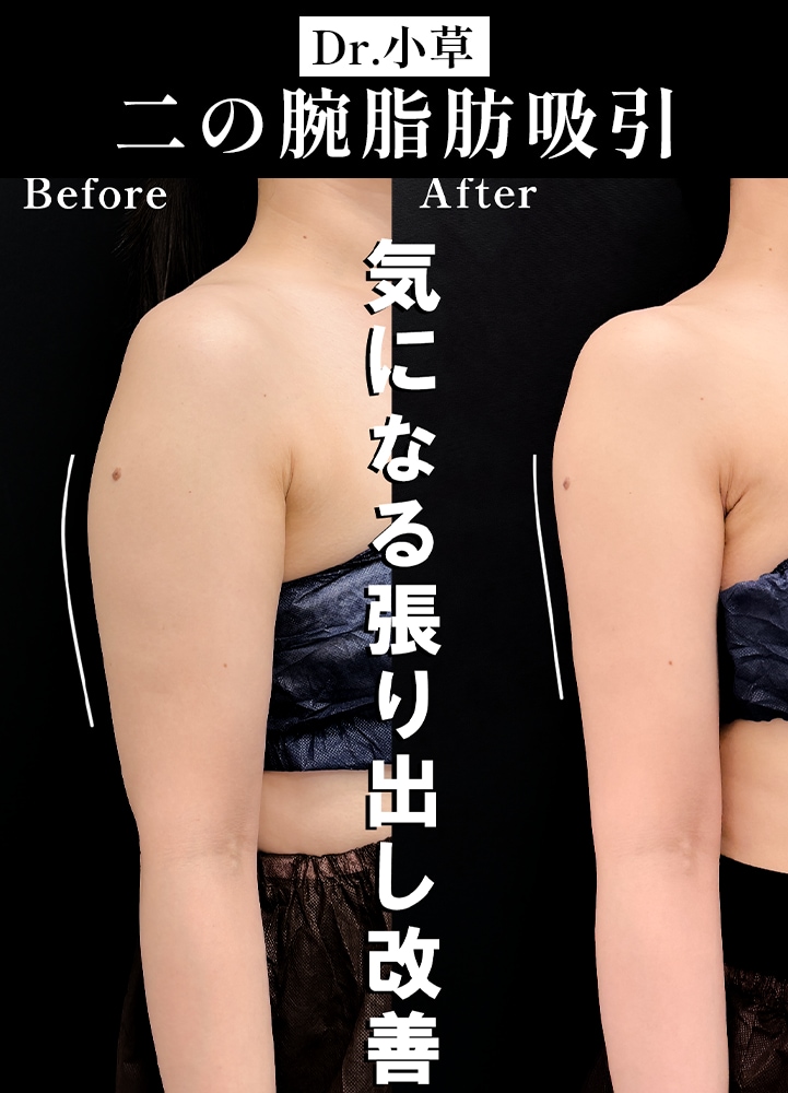 【二の腕脂肪吸引の名医】40代の大人のナチュラル美腕デザイン「たるみ・厚み」を克服する【二の腕脂肪吸引が上手いおぐさ先生】