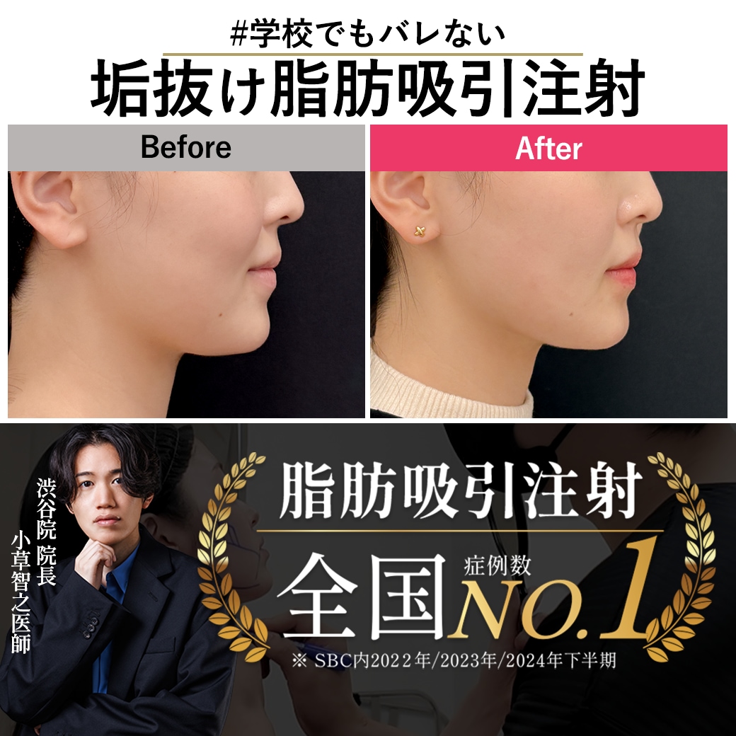 【顔の脂肪吸引注射】ダウンタイム・圧迫バンドなし！学校を休まず垢抜ける、学生に選ばれる名医。